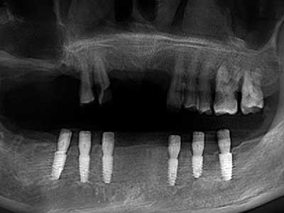 下半口修復病例